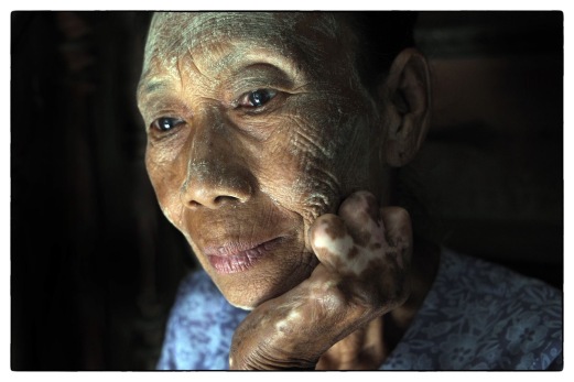 Taken as part of on-going project concerning Leprosy in the Modern World. Pictured here is an elderly lady living in a rural village within Upper Myanmar, formerly known as Burma.